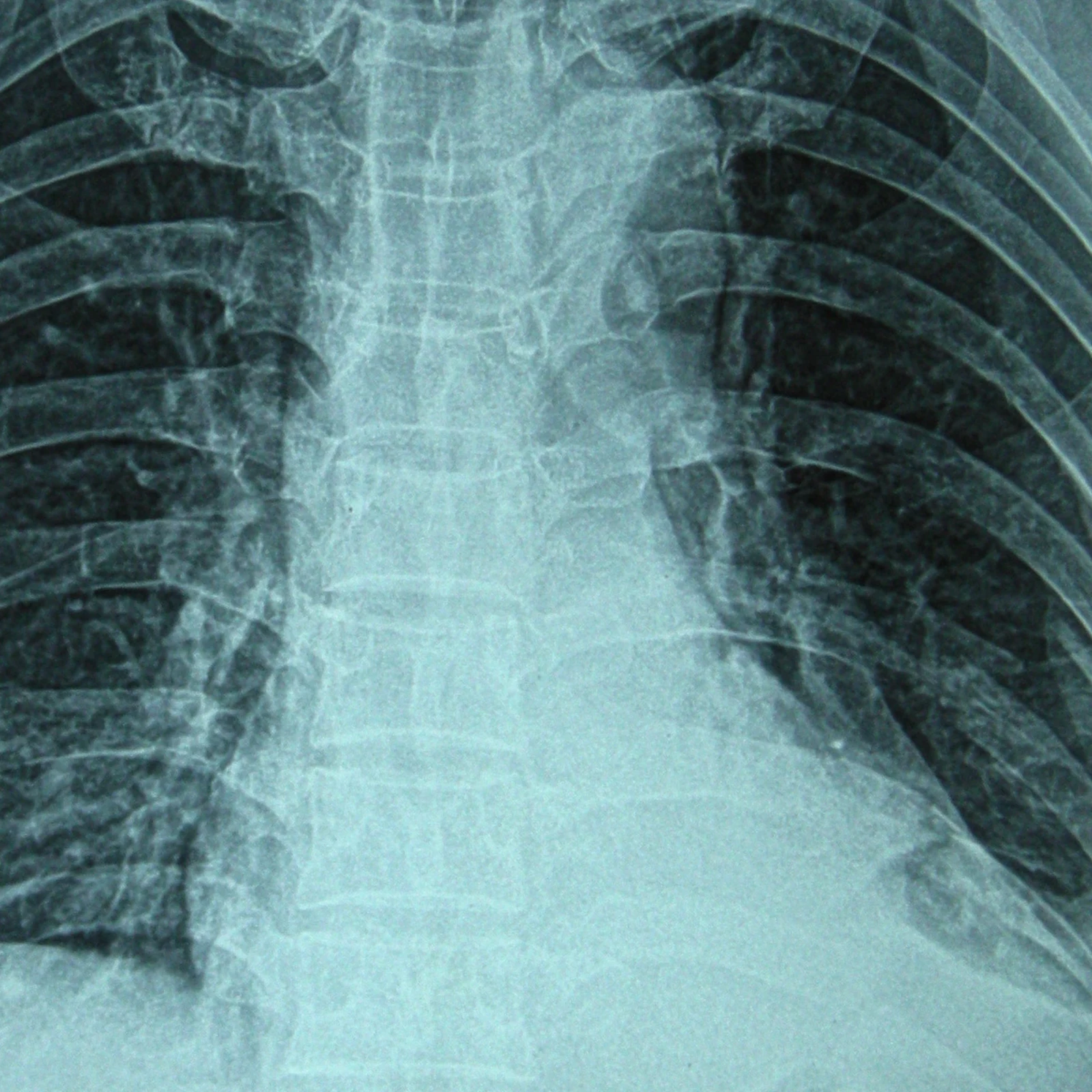 rib fracture settlement word2
